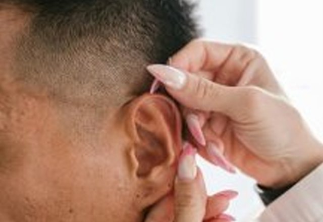 Afvallen met behulp van acupunctuur
