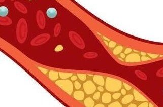Je cholesterol verlagen