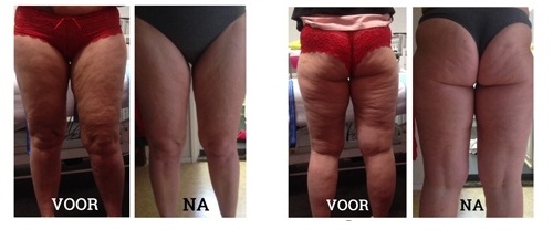 Voor en na foto's bij anti cellulite behandeling